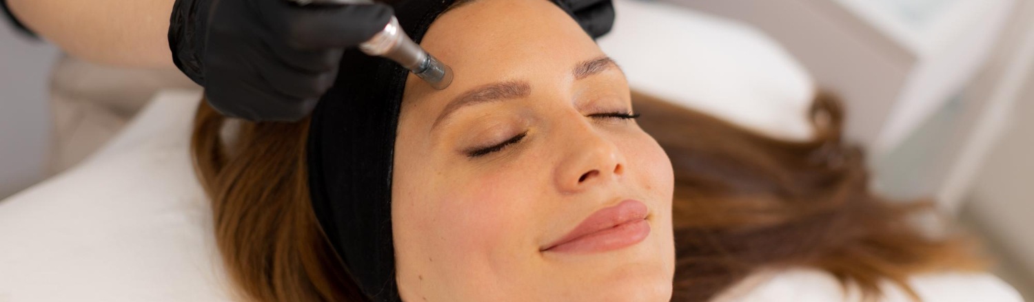 Microneedling sur une femme